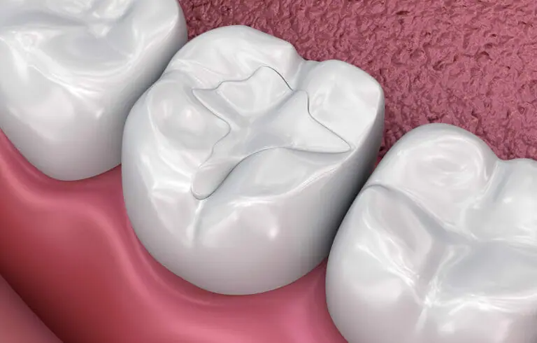 How long do tooth fillings last? Lifespan and Durability of Tooth Fillings Explained