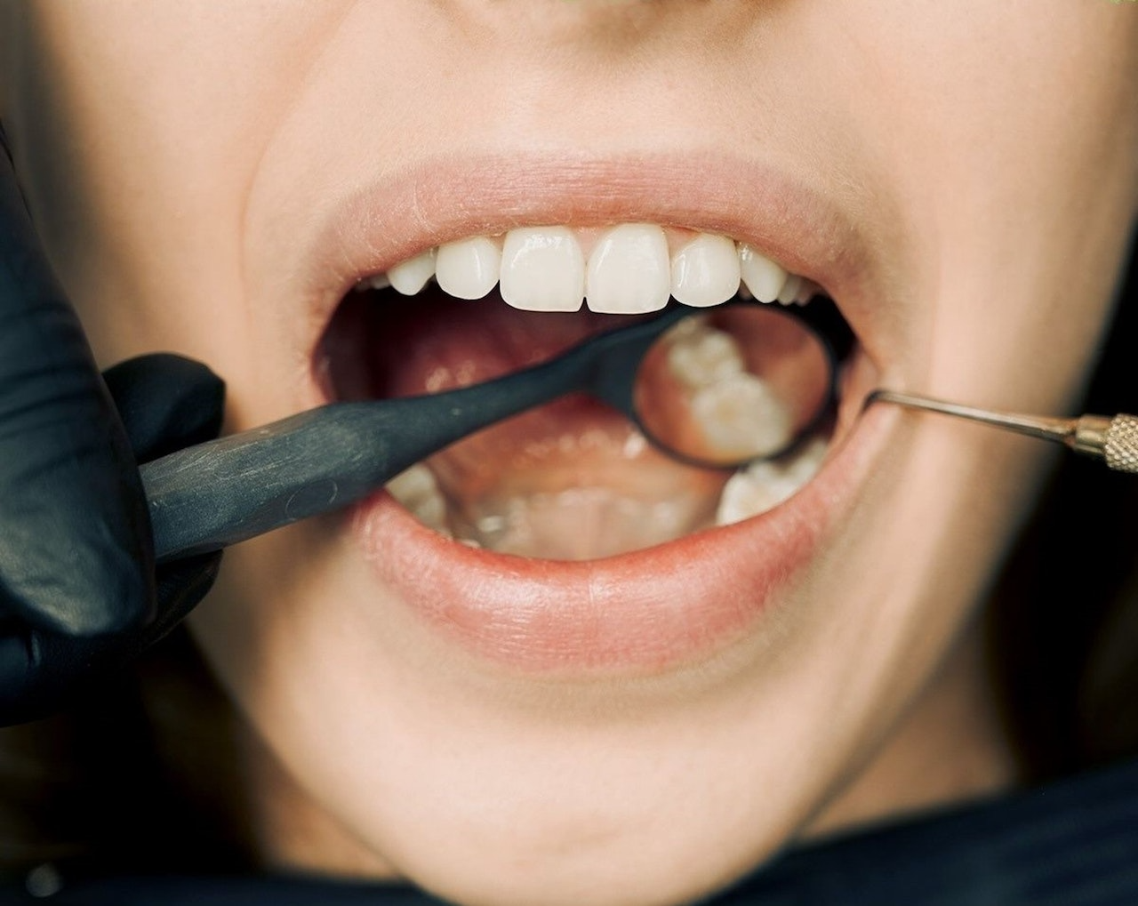 Why do tooth fillings fall out? Common Reasons for Tooth Fillings Falling Out